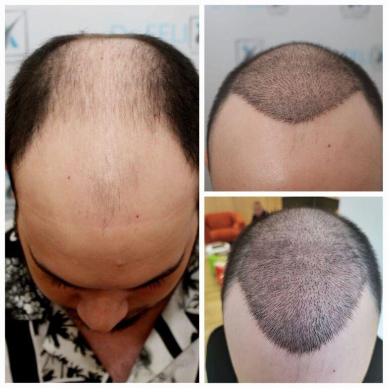 Pentru bărbați, părul lipsă este egal cu încredere în minus. Află de aici alte informații de interes